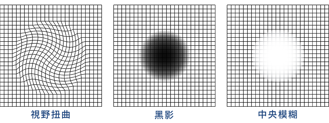 黃斑病變治療 內容及收費 希瑪眼科中心