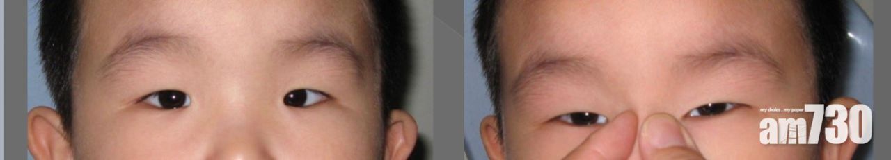 1621844968146149.jpg 斜視眼影響深遠 及早糾正救視力.jpg