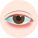 眼表及角膜疾病
